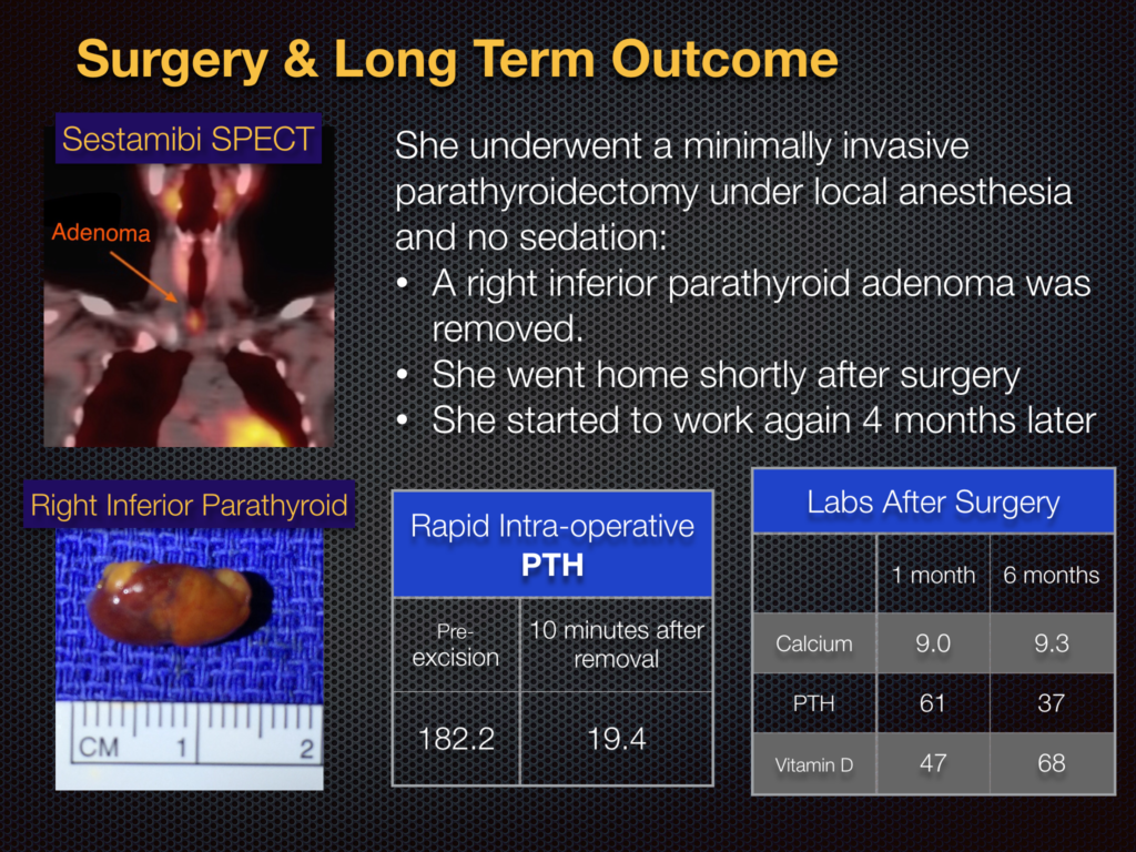 diagnosis-hyperparathyroidism-surgery-dr-babak-larian