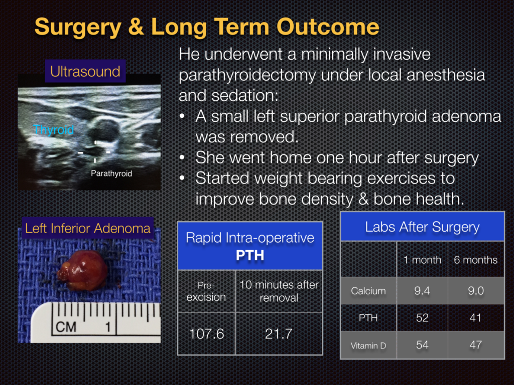 diagnosis-hyperparathyroidism-surgery-dr-babak-larian