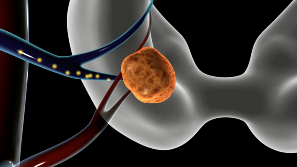 Parathyroid Adenoma Dr Larian Hyperparathyroidism Surgery Dr