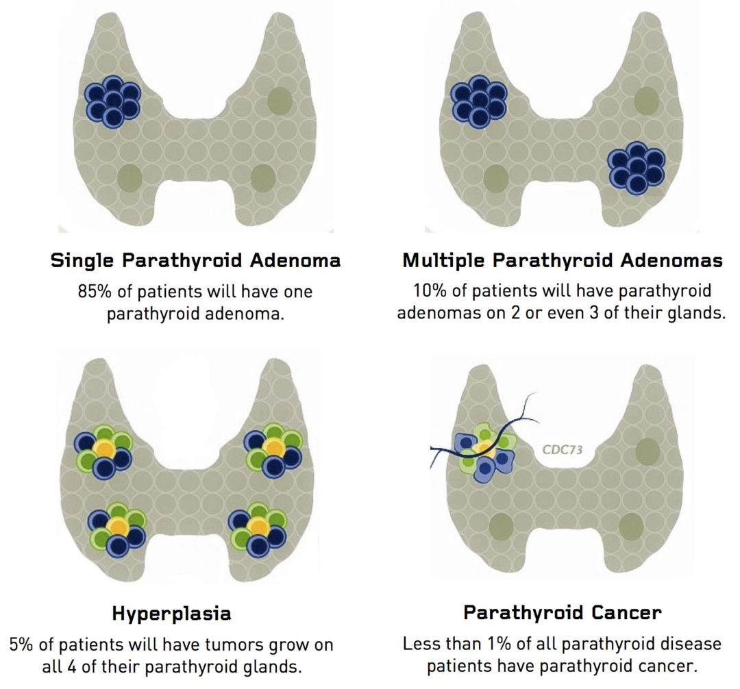 Parathyroid Adenoma Hyperparathyroidism Surgery Dr Babak Larian