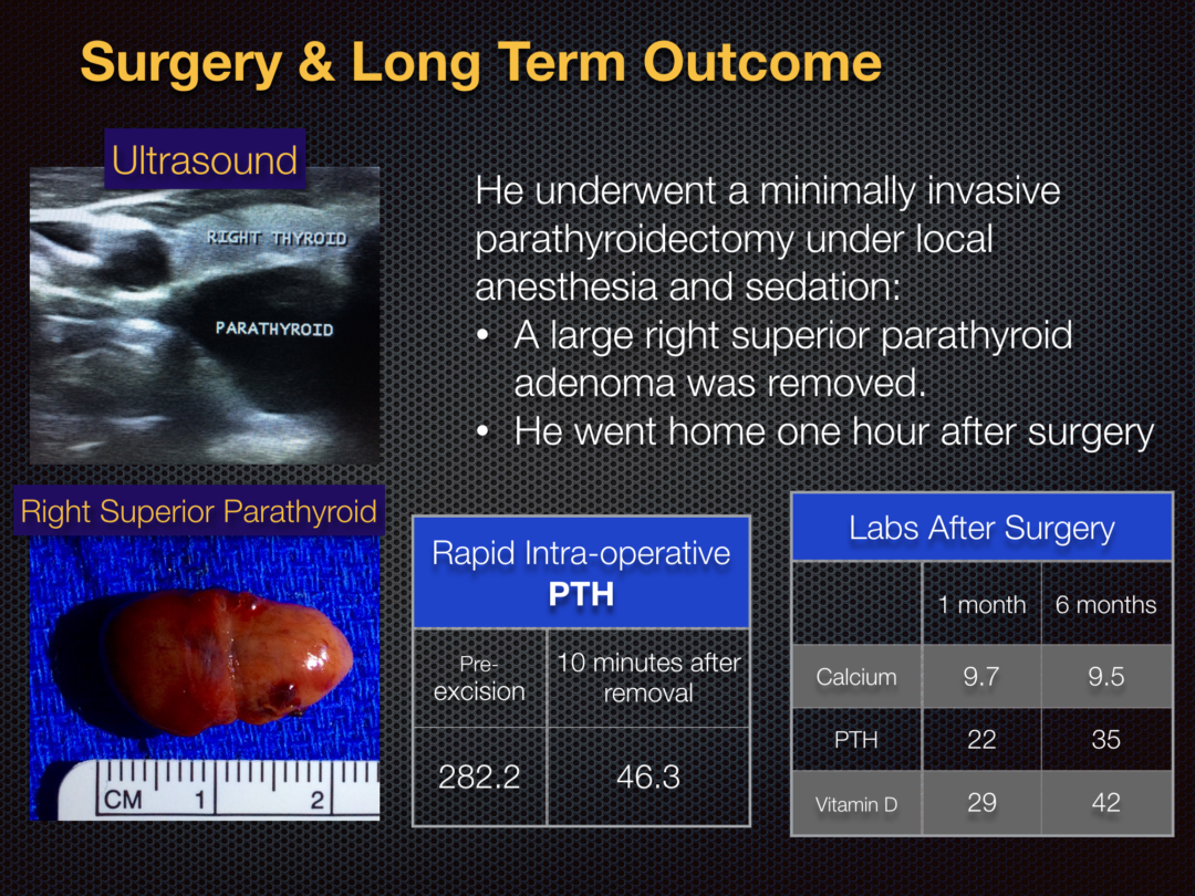 Img 0810 Hyperparathyroidism Surgery Dr Babak Larian