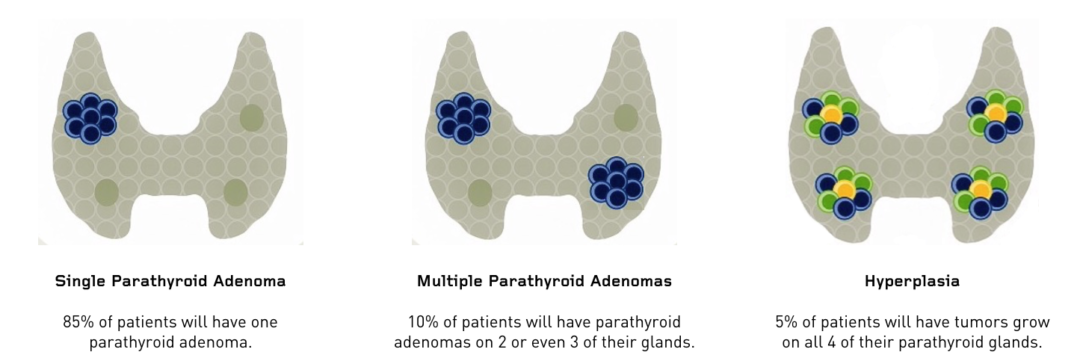 Types-of-parathyroid-tumors - Hyperparathyroidism Surgery - Dr. Babak ...