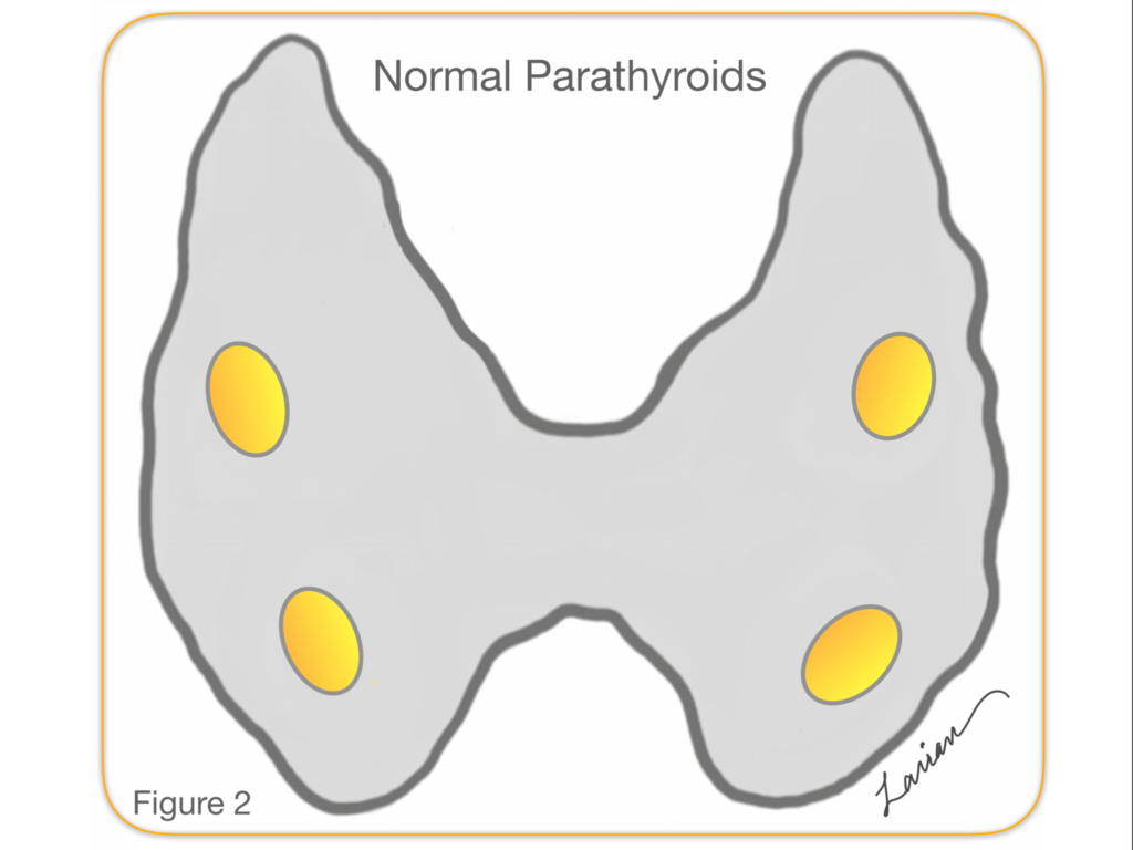 Figure 2 Hyperparathyroidism Surgery Dr Babak Larian