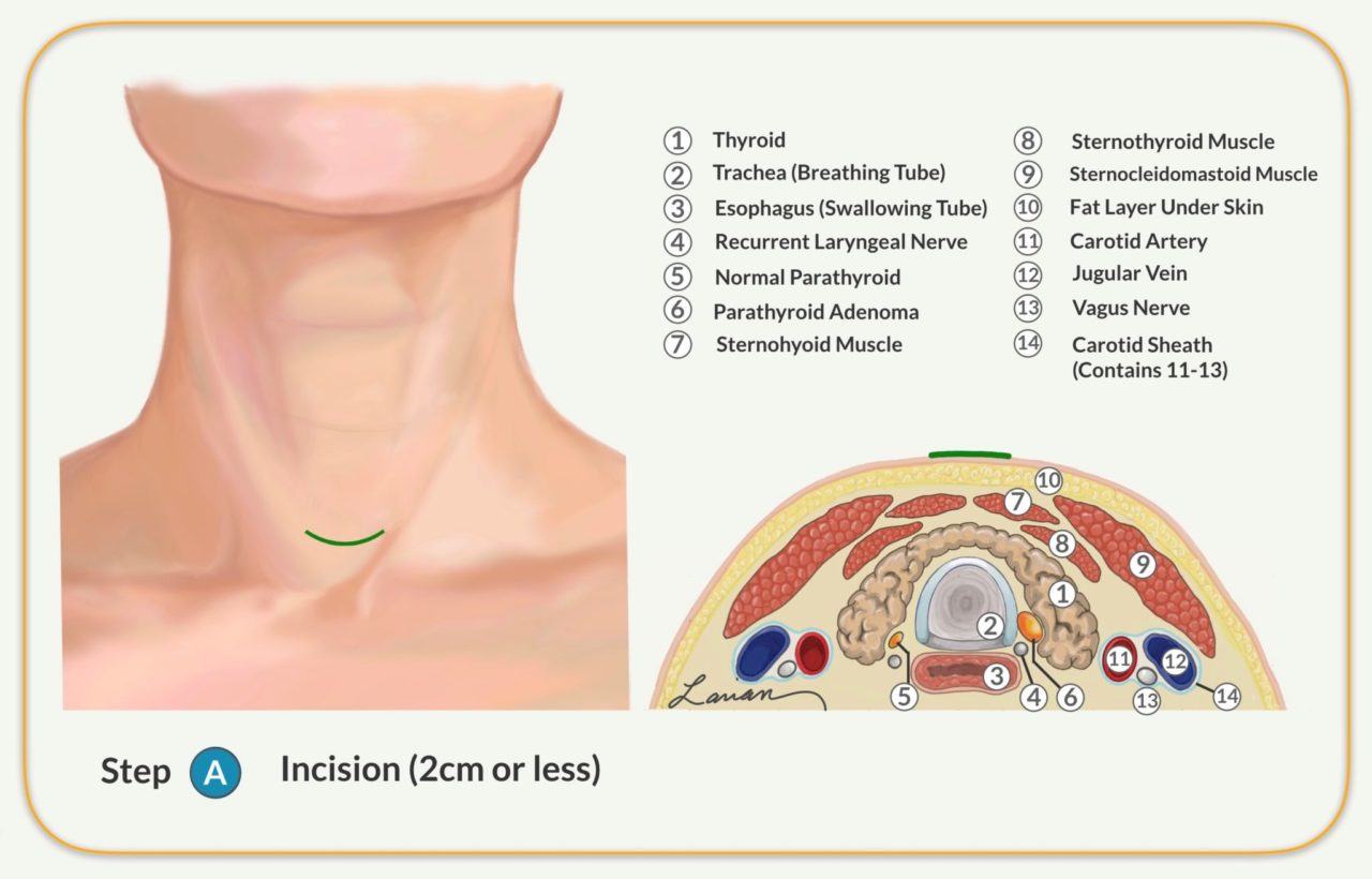 Parathyroidectomy Parathyroid Gland Removal Surgery Dr Larian