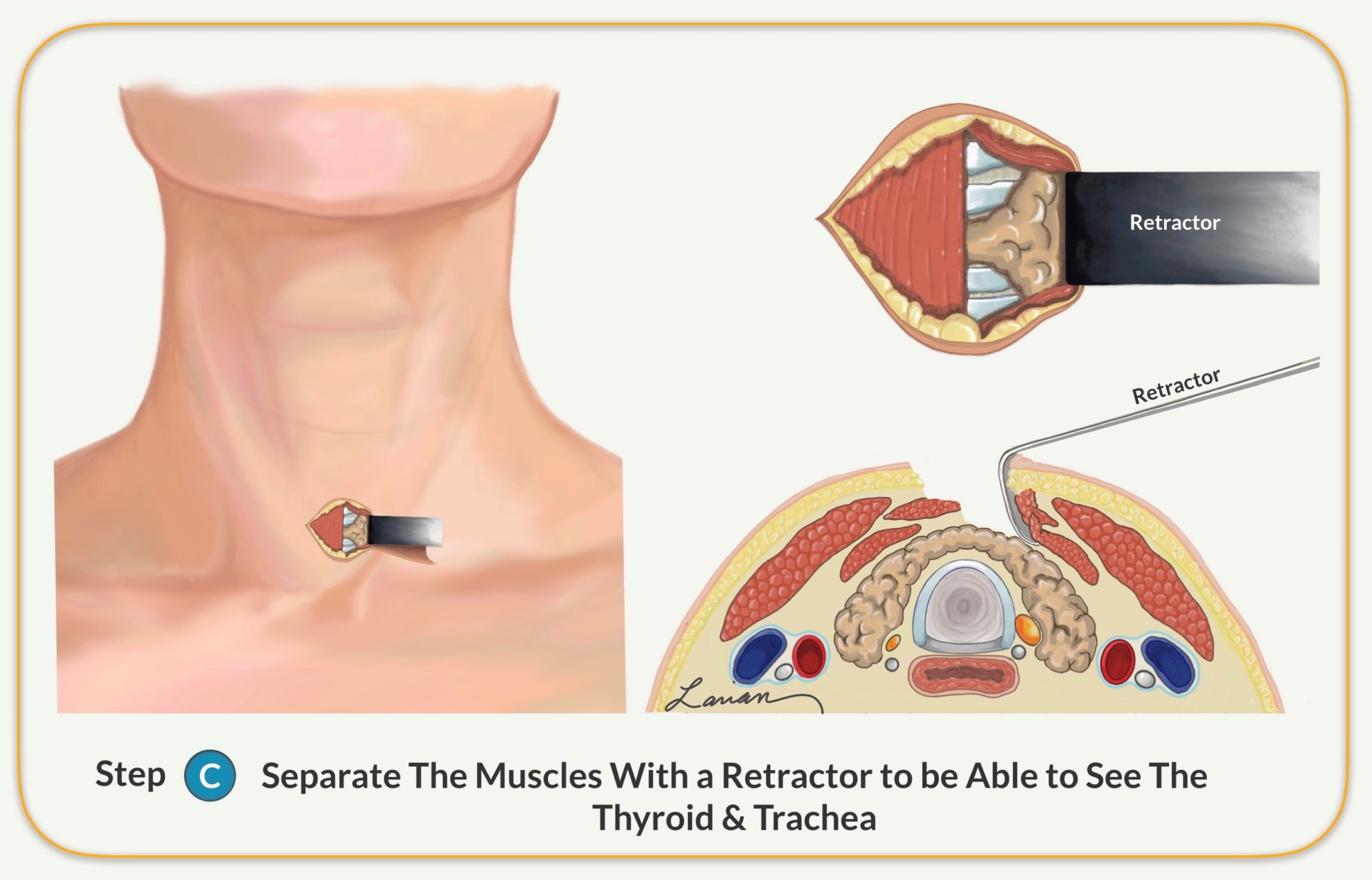 Parathyroidectomy Parathyroid Gland Removal Surgery Dr Larian