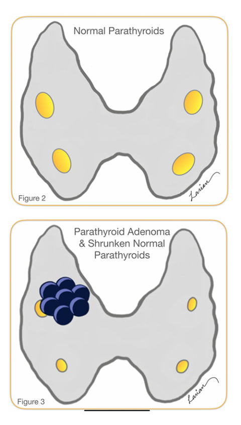 Parathyroidectomy - Parathyroid Gland Removal Surgery | Dr. Larian