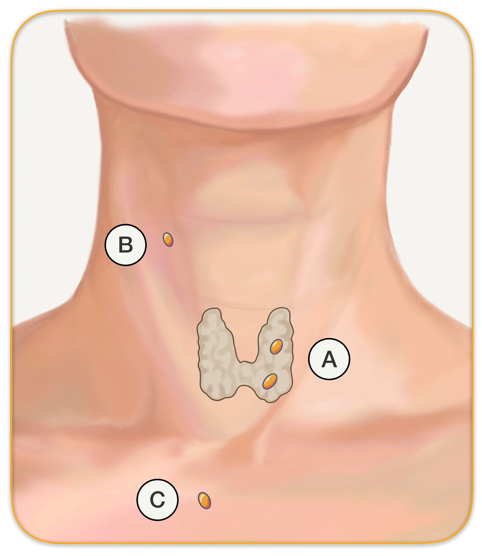 Parathyroid Glands in Throat and Neck - Hyperparathyroidism Surgery ...