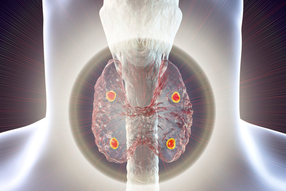 can-hyperparathyroidism-be-cured-naturally-dr-babak-larian