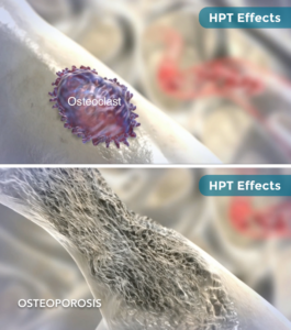 HPT and osteoporosis