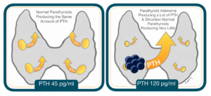 illustration of normal parathyroid vs. parathyroid adenoma producing PTH